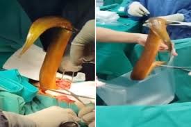 Indian Man Faces Life-Threatening Situation After Inserting Live Eel into Anus