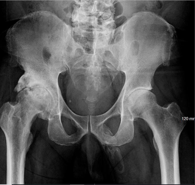 Doctors Discover Rare Penile Bone Growth in 63-Year-Old Man Following X-ray for Knee Pain